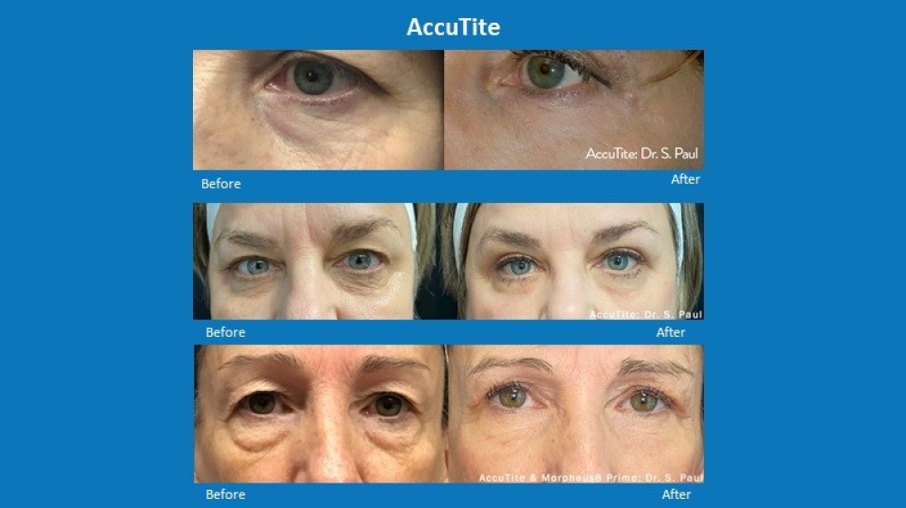 Before and After