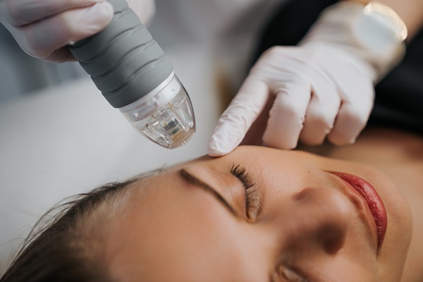 Improve The Texture Of Your Skin With Microneedling